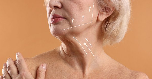 Was versteht man unter einem diagonalen Vektor bei der Gesichtsstraffung?